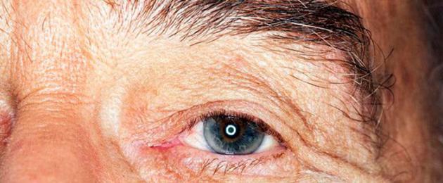 Отслоение сетчатки глаза название болезни. Симптомы и лечение отслоения сетчатки глаза