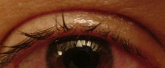 Обострения увеита. Увеит (воспаление сосудистой сетки глаза): фото, симптомы и лечение