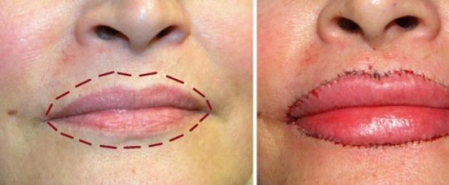 Увеличить губы навсегда без операции. Как увеличить губы в домашних условиях? Полезные упражнения для увеличения объема губ